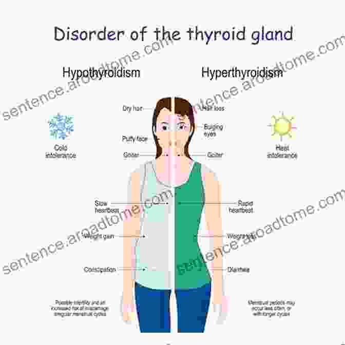 A Diagram Of The Thyroid Gland And Common Thyroid Disease Complications Common Thyroid Disease Complications James M Lowrance