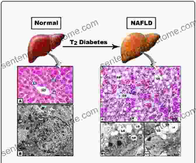 A Microscopic Image Showing Fatty Liver Disease Associated With CF Kids With Cystic Fibrosis: A Great Role Model For Children With Cystic Fibrosis: Update On Key Emerging Challenges In Cystic Fibrosis