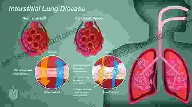 An Illustration Of Inflamed Lung Tissue Due To Chronic Lung Disease Kids With Cystic Fibrosis: A Great Role Model For Children With Cystic Fibrosis: Update On Key Emerging Challenges In Cystic Fibrosis