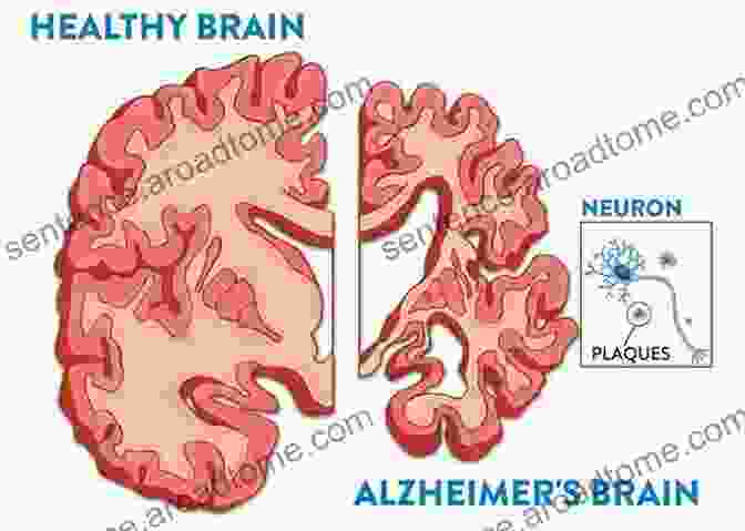 Brain Scan Showing The Effects Of Alzheimer's Disease What If It S Not Alzheimer S?: A Caregiver S Guide To Dementia