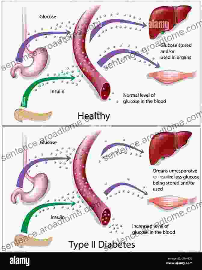 Diagram Illustrating The Causes And Effects Of Type 2 Diabetes Type 2 Diabetes Putting Diabetes In Its Place: A Simple Guide To Naturally Reverse Type 2 Diabetes Living A Normal Healthy Life