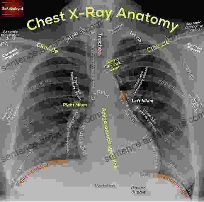 Example Of A Chest X Ray With Annotations Indicating Anatomical Structures Radiographic Imaging And Exposure E (Fauber Radiographic Imaging Exposure)