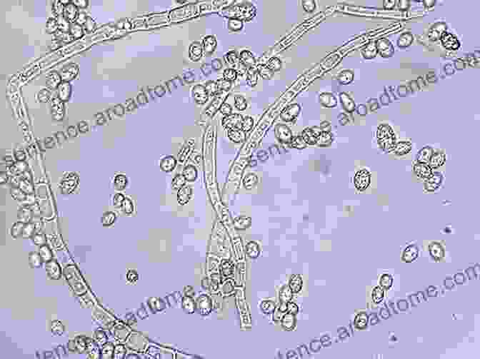 Fungal Hyphae And Spores Under A Microscope Fungal Infections In Tissue (Digital Microscopy Video): Volume 13