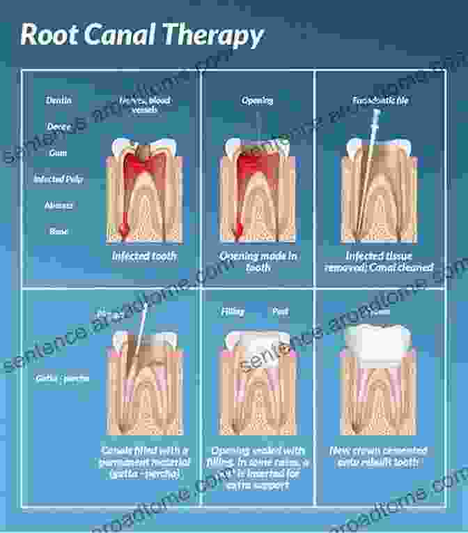 Image Depicting The Diagnosis And Treatment Planning Process In Endodontics Harty S Endodontics In Clinical Practice