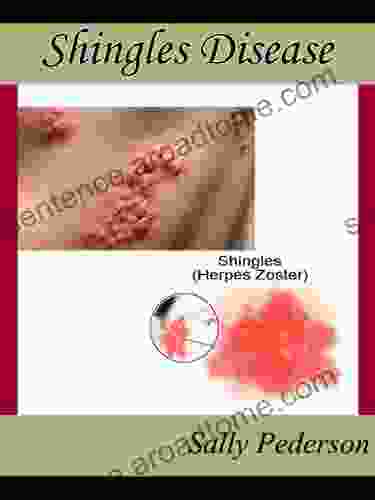 Shingles Disease The Complete Guide Everything You Need To Know About Shingles Disease From What Causes Shingles To Treatment For Shingles And Everything In Between